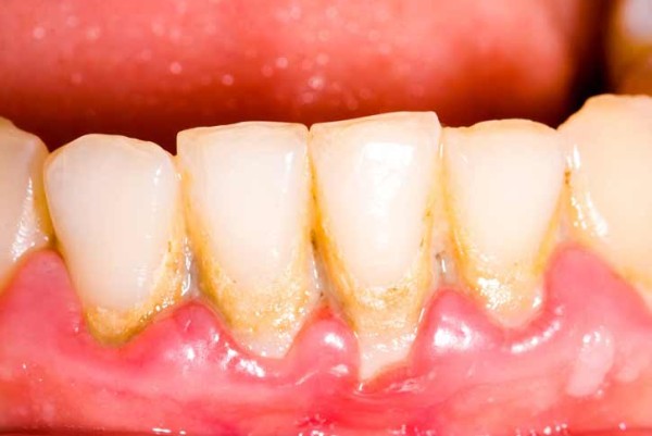 Home-Remedies-to-Clean-Teeth-Plaque