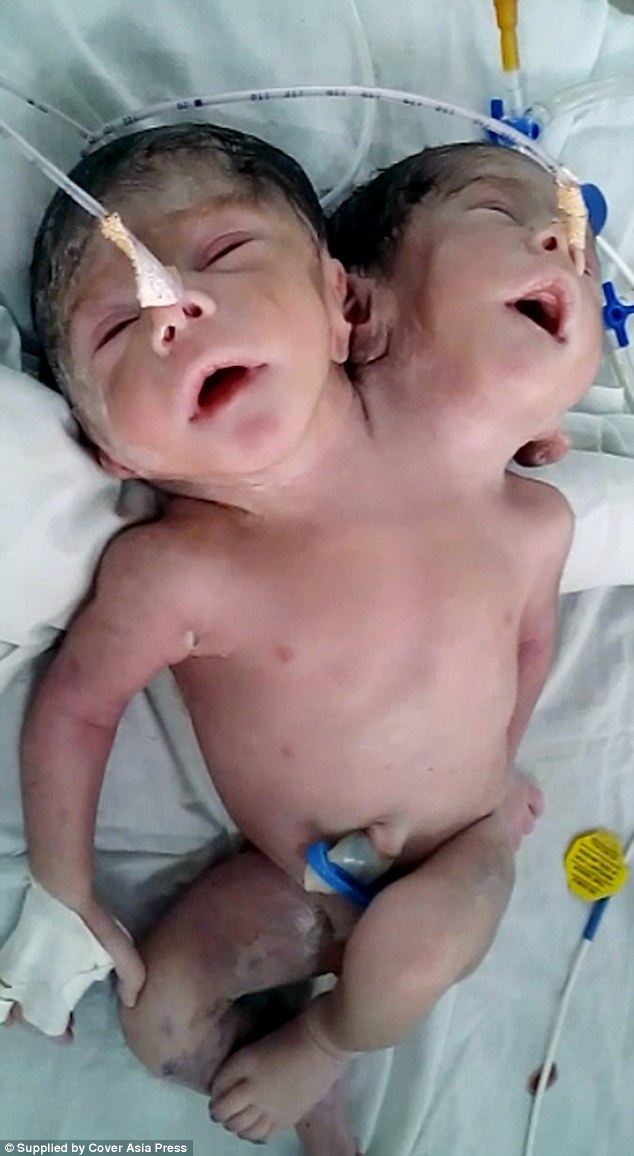A baby boy bearing two heads has been born in India and has been described as a 'miracle' by doctors