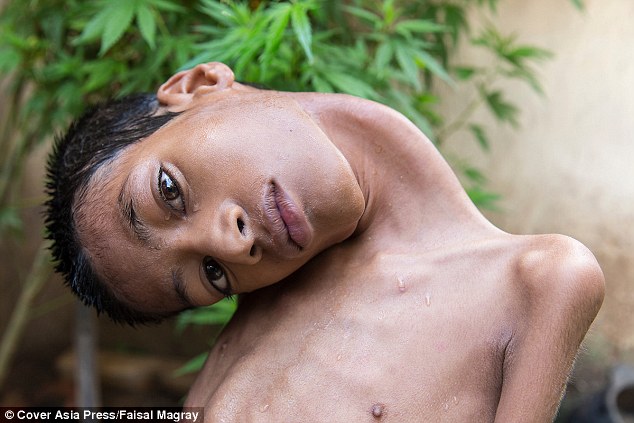  Crocked: Schoolboy Mahendra Ahirwar (pictured) has a rare condition which made his neck muscles so weak that his head hung to one side and he saw the world at a 180-degree angle