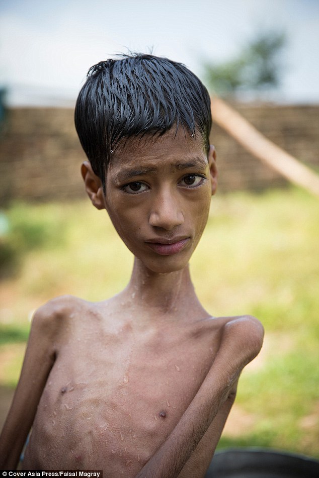 But thanks to life-changing surgery, Mahendra, 13, above, can now finally see the world the right way up after he had an operation to straighten his neck