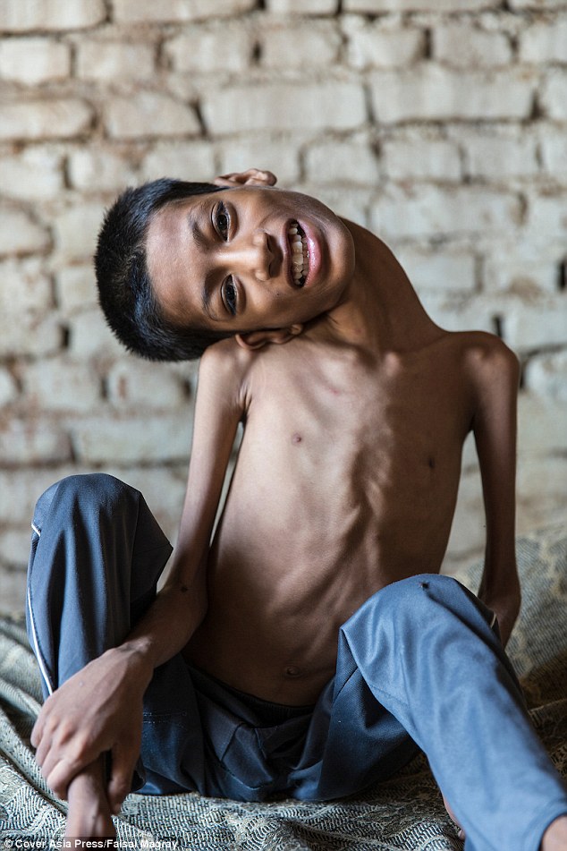 Prior to surgery, his mother Sumitra, 36, said: 'I can't see Mahendra suffer anymore. Watching his life is devastating. He cannot do anything by himself.' She added: 'He just sits in a corner of the room all day. It's no life. I have to carry him like a baby everywhere.'
