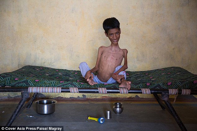 Before surgery Mahendra needed his mum to feed, bathe and dress him. His younger siblings Surendra, 11, and 14-year-old Manisha, both went to school. And his older brother Lalit, 17, tried to find work. Meanwhile he was left at home. Even his friends used to ignore him 