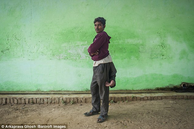 Arun Kumar (pictured) lives in Farrukhabad in Uttar Pradesh where locals urged his parents to accept his deformities when he was a child. But now he wants some help