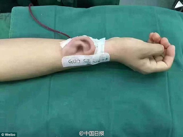 The doctor is set to transplant the ear from the patient's arm to his head once it is fully grown