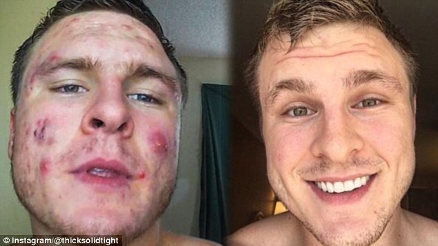 Before and after: U.S. bodybuilder Brian Turner was able to eliminate his acne 