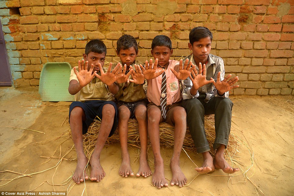 Raju Choudhary, 11, Pintu Choudhary, 10, Pawan Choudhary, 10, and Sunny Choudhary, 14 pose for a picture while showing their 12 fingers and 12 toes