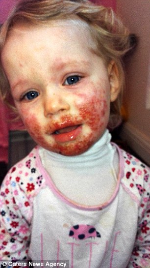 Sienna Duffield, 3, suffered from painful blisters across her face after catching herpes from kissing a family member