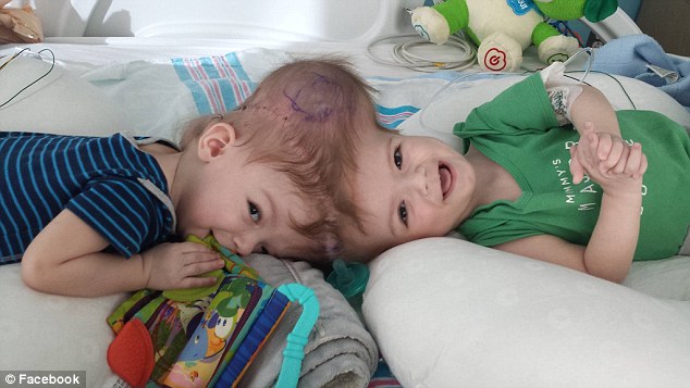 They shared every second of their lives together until last month. But Jadon and Anias , twins conjoined at the crown of their heads, never caught a glimpse of their closest companion