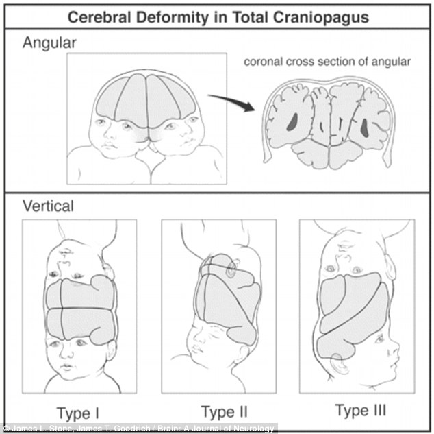 This is a diagram to demonstrate the way craniopagus twins can be connected