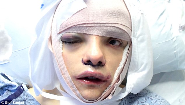 The 20-year-old transgender woman from Toronto recently underwent Facial Feminisation Surgery (pictured) - sharing a graphic video on her popular YouTube page about the procedure