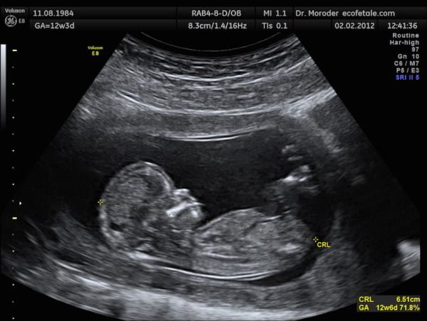 怀孕多次妈妈去照超音波照，拍到恐怖「宝宝一脚穿出子宫」全世界只有26起案例！