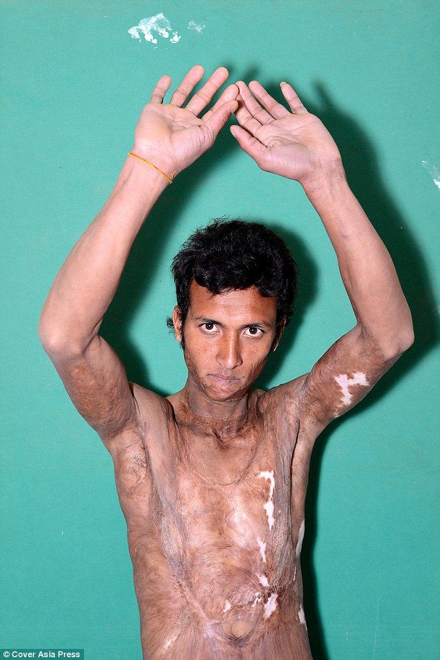 Tragic: Tej Biswokarma, now 21, was just five years old when a kerosene oil lamp blew up in his face. Since he's had life-changing surgery he say he feels 'reborn'