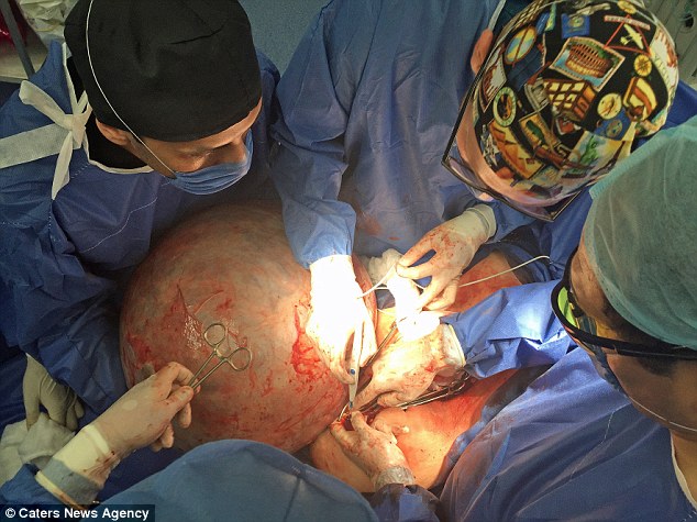 Danger: Up to 20% of giant ovarian cysts are malignant, meaning that if the cyst was pierced it risked leaking tumorous cells into the patient's body