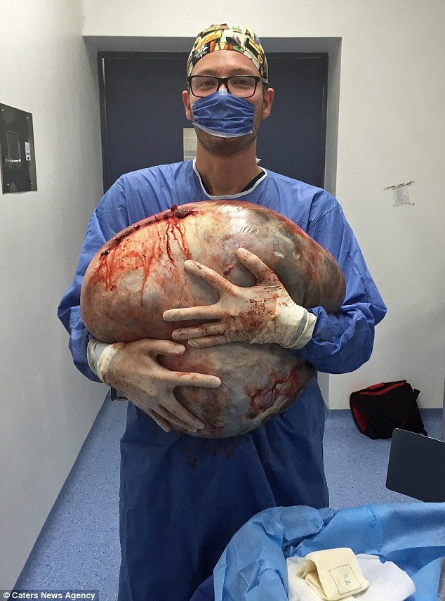 Heavy load: Dr Erik Hanson Viana poses with the giant cyst after the five-hour surgery