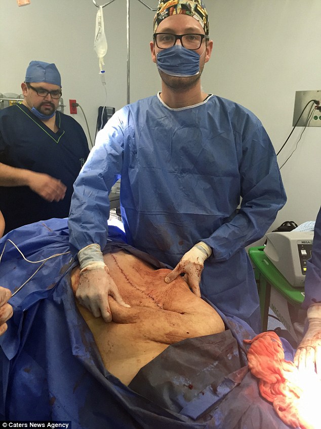 Post-operative: Dr Hanson tries to tidy the excess folds of skin that were slowly stretched 