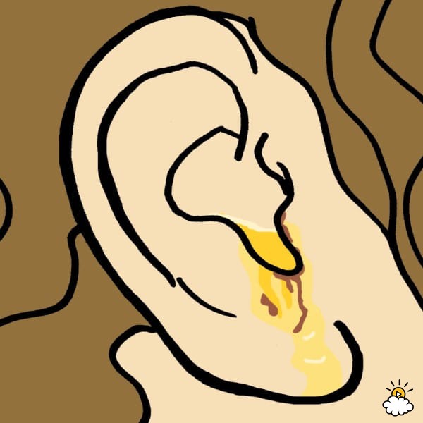 Earwax Type #8: Wet And Runny