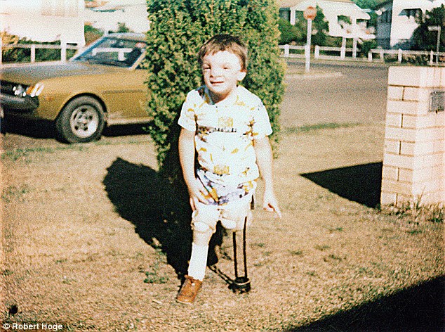 Young boy: The writer, from Brisbane, Australia, pictured as a child, said he was born with 'tennis ball-sized' tumor in the middle of his face and 'mangled' legs