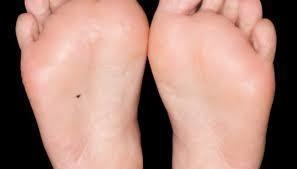 A mole at the bottom of the feet symbolizes someone who needs to travel. 