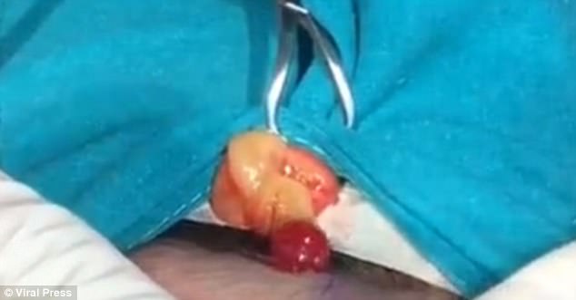 It is believed that Ms Guang is now fine after undergoing the procedure to remove the infected clump of pus