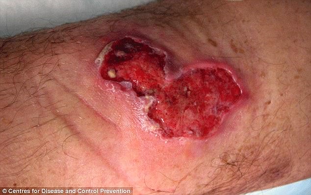 Flesh-eating bacterial disease Daintree ulcer has struck northern Queensland (file picture)