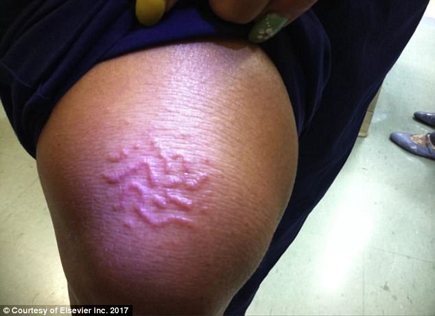 The 45-year-old woman developed a rash (pictured) caused by a parasitic infection known as cutaneous larva migrans. But the source of it was extremely rare: it came from a worm that normally only infects dogs