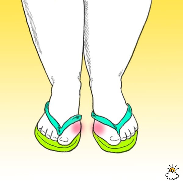 <u>Why Are Flip-Flops Bad For You?</u><br>#1: They Cause Bunions