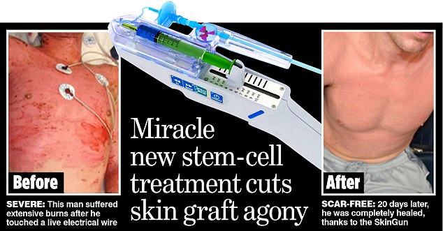 Burns victims are making incredible recoveries thanks to a revolutionary ‘gun’ that sprays stem cells on to their wounds, enabling them to rapidly grow new skin