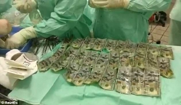 Surgeons extracted 57 $100 bills from a 30-year-old Colombian woman who swallowed $7,000 in cash 