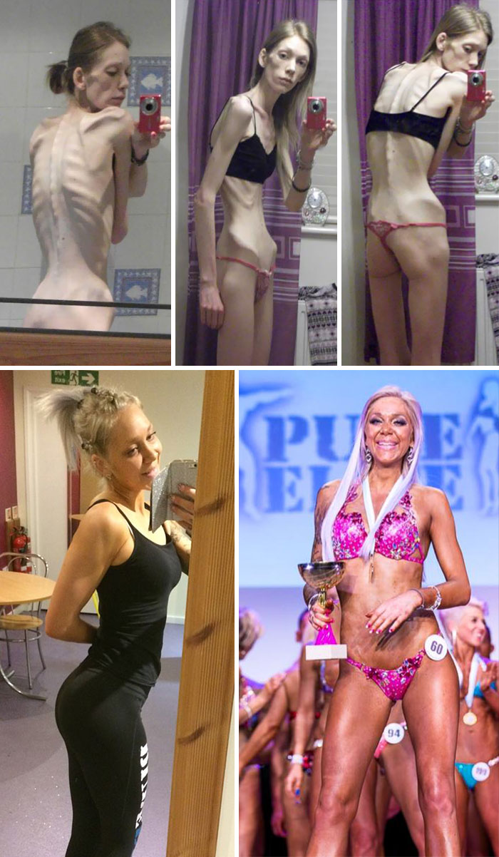 Nicola King, Who Was Told To Say Goodbye To Her Loved Ones When Her Eating Disorder Saw Her Organs Fail, Has Battled Her Way Back To Health And Was Crowned A Body Building Champion