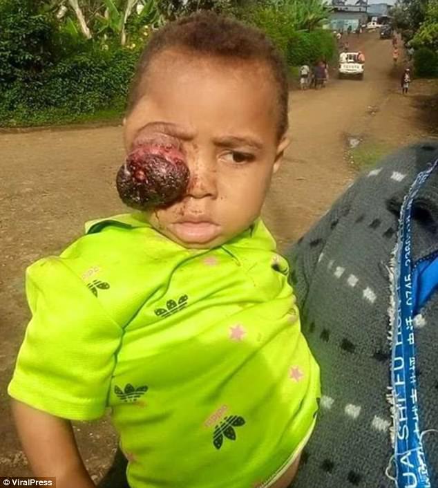 Bongre Anton Peter, from Papua New Guinea, began to show signs of retinoblastoma in his right eye when he was a year old in March 2015
