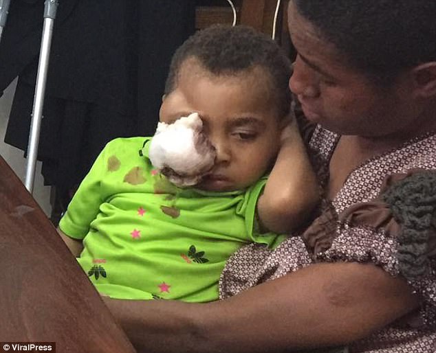 When painkillers and eye drops failed to stop the tumour growing, his desperate parents, from the remote Eastern Highlands of Papua New Guinea, instead turned to black magic to cure it (pictured with his father, Peter Anton)