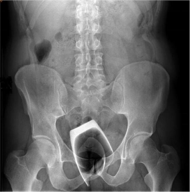 The unnamed patient, believed to be from Milan, told doctors he put the 6x8cm drinking glass up his bottom for 'sexual stimulation' (pictured: an X-ray taken before it was removed)